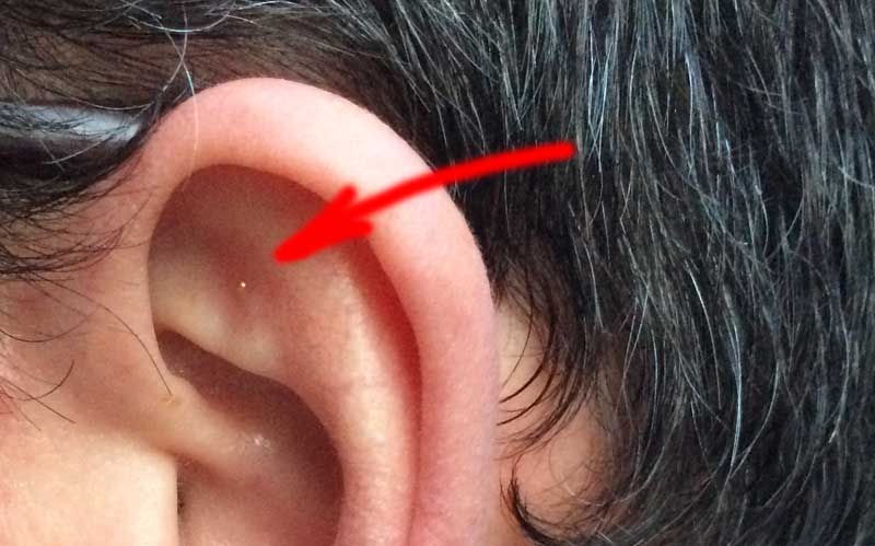 The author has auricular acupuncture using a pellet.